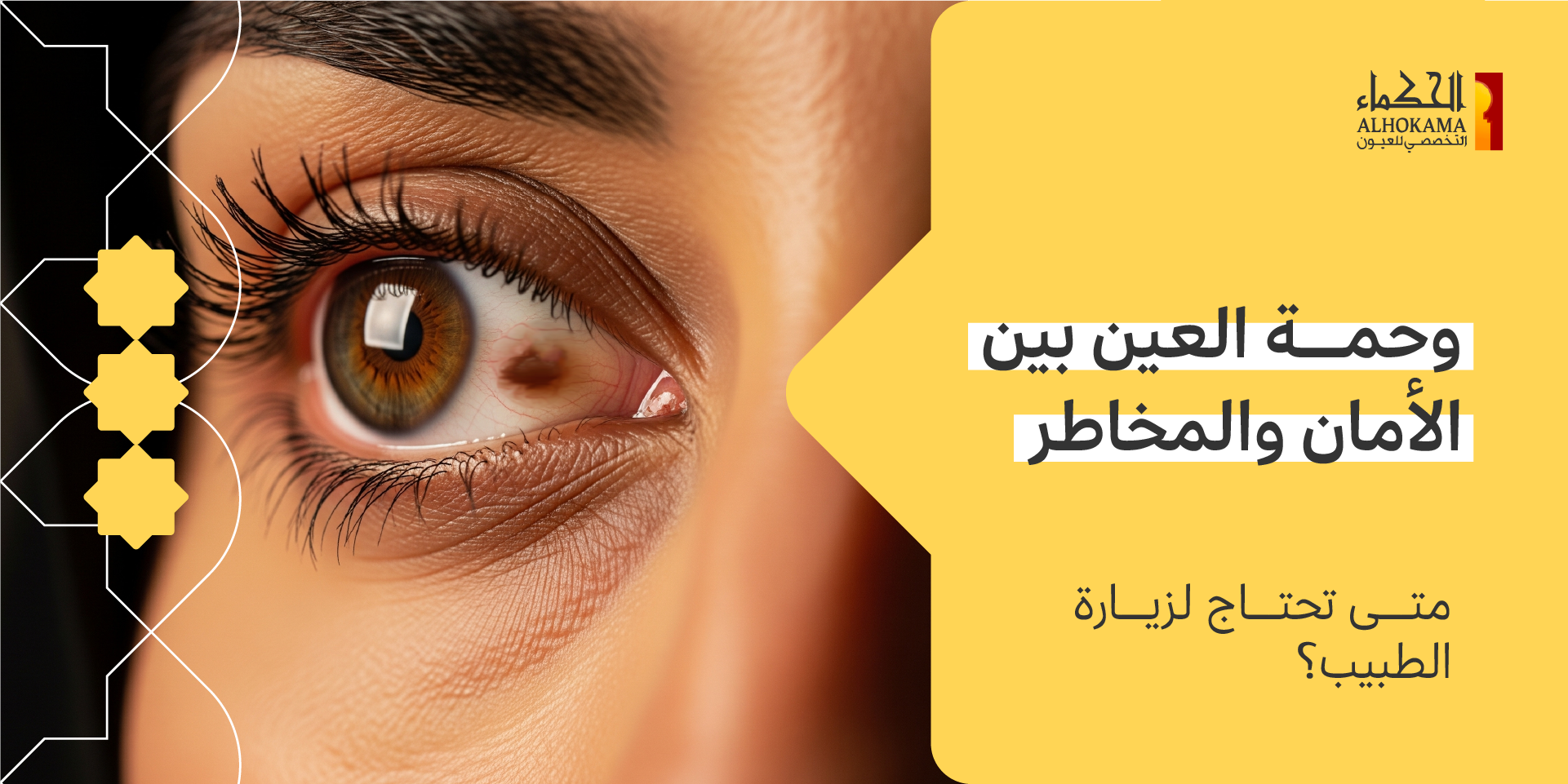 وحمة العين