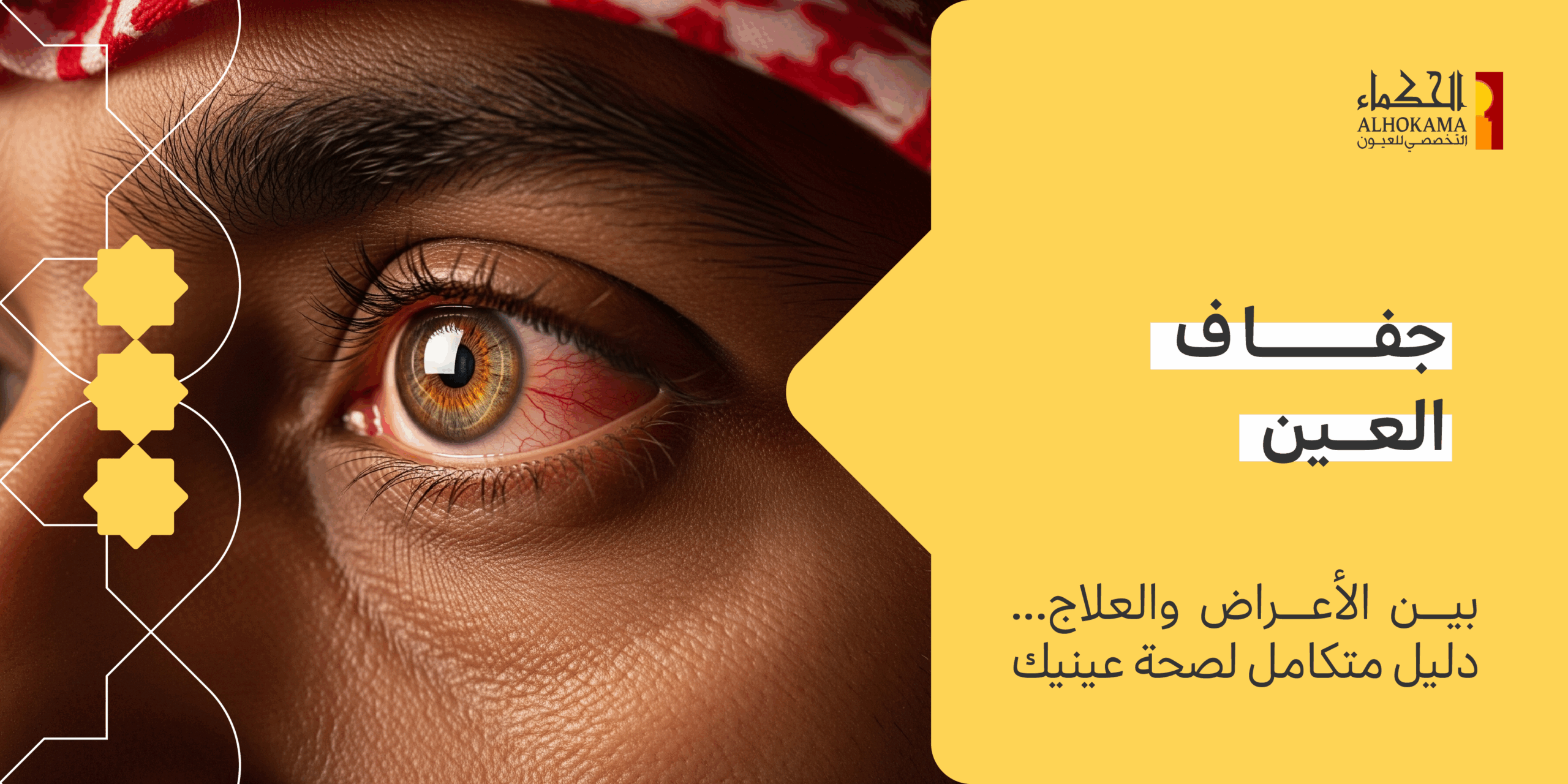 جفاف العين