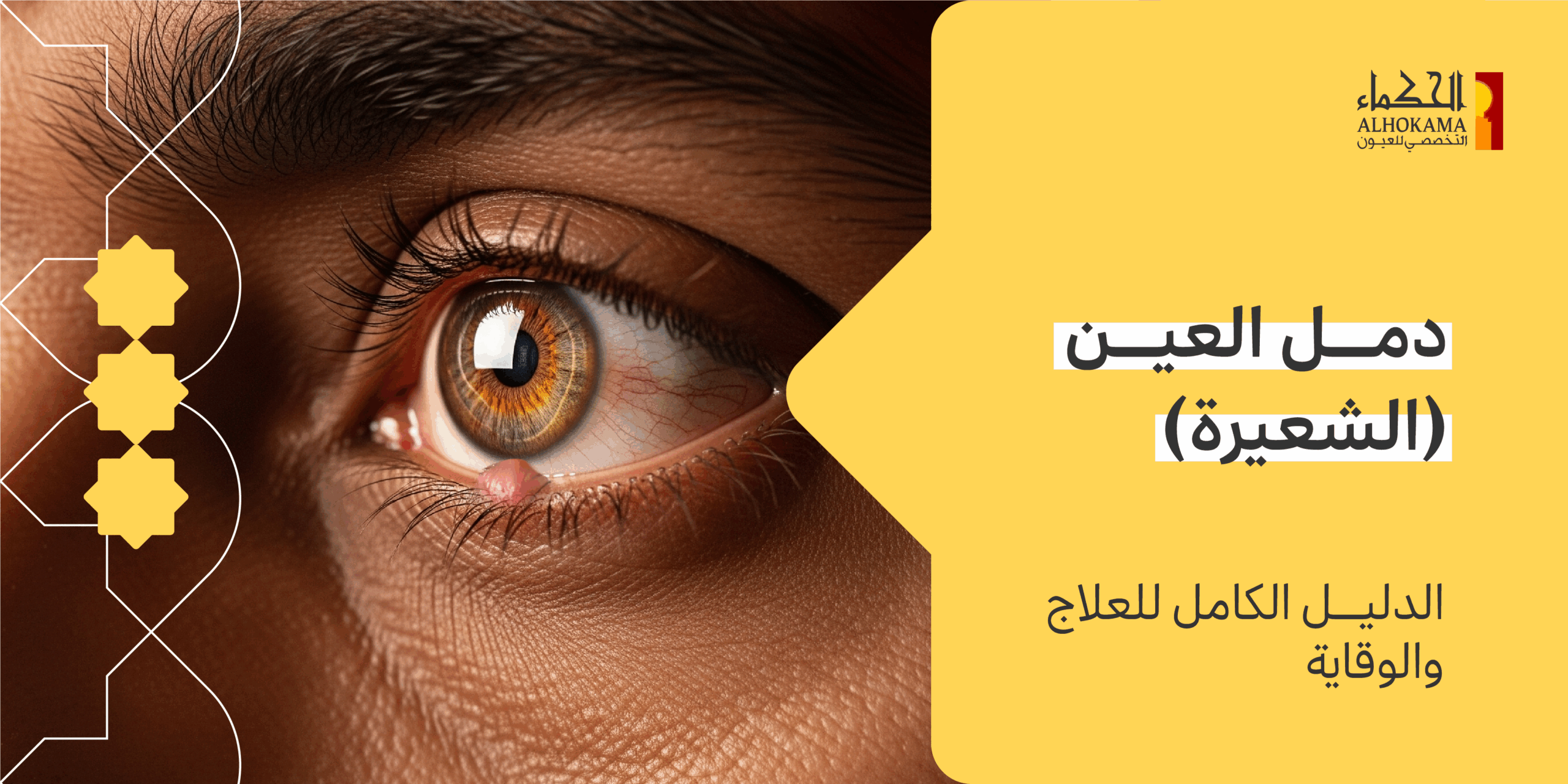 دمل العين