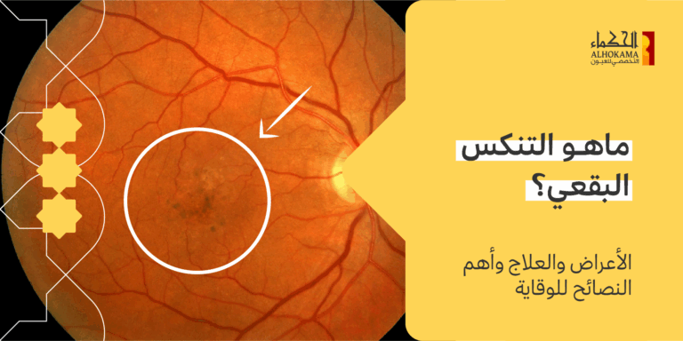 التنكس البقعي