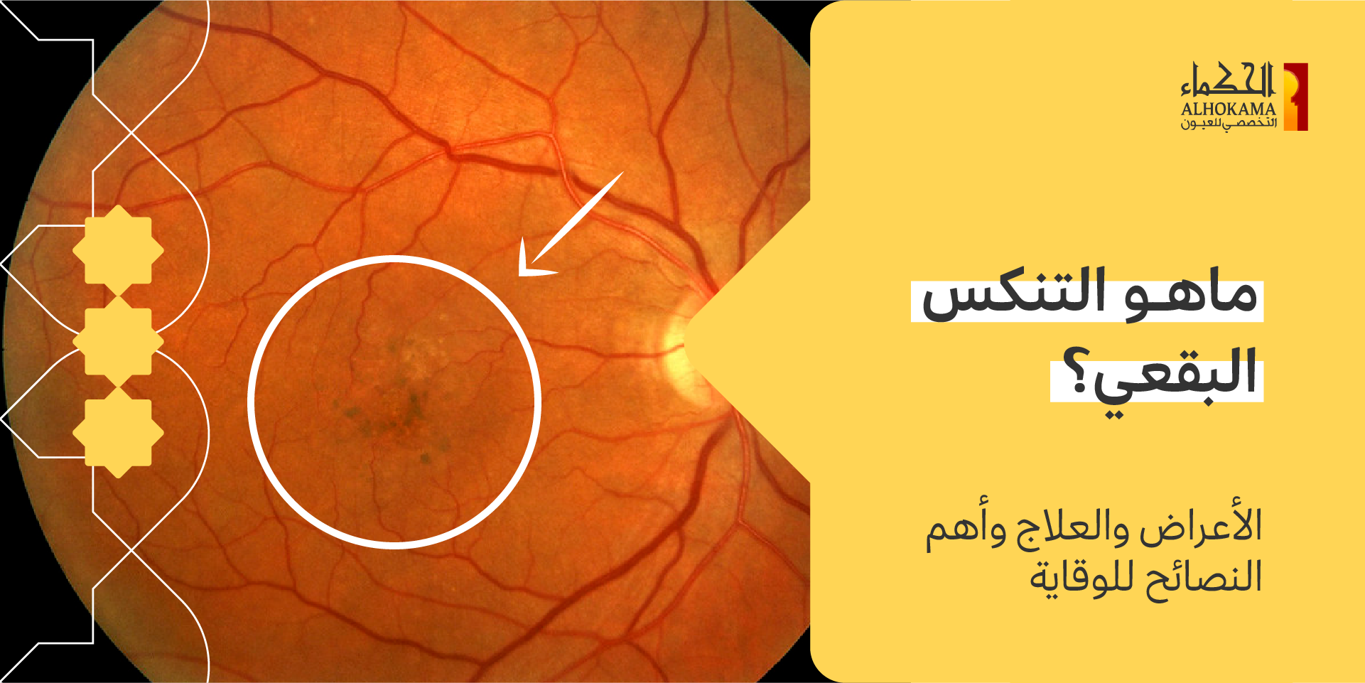 التنكس البقعي