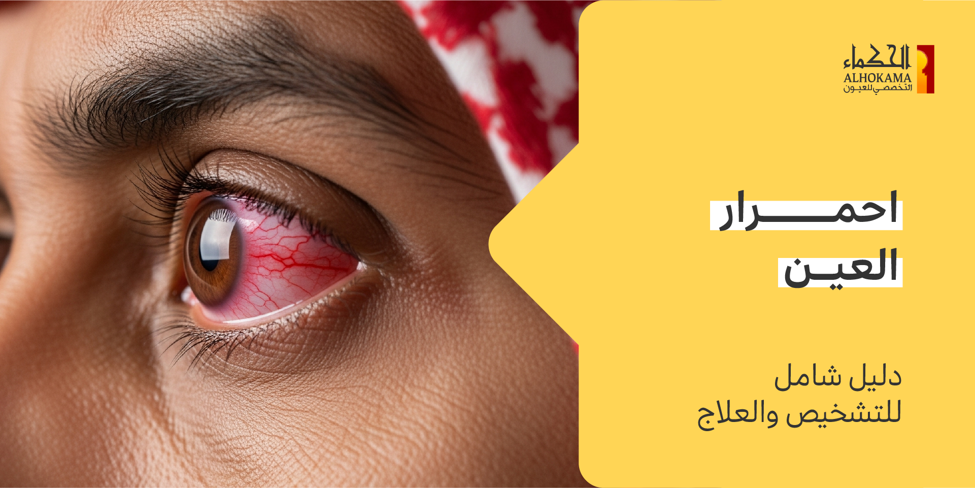 احمرار العين