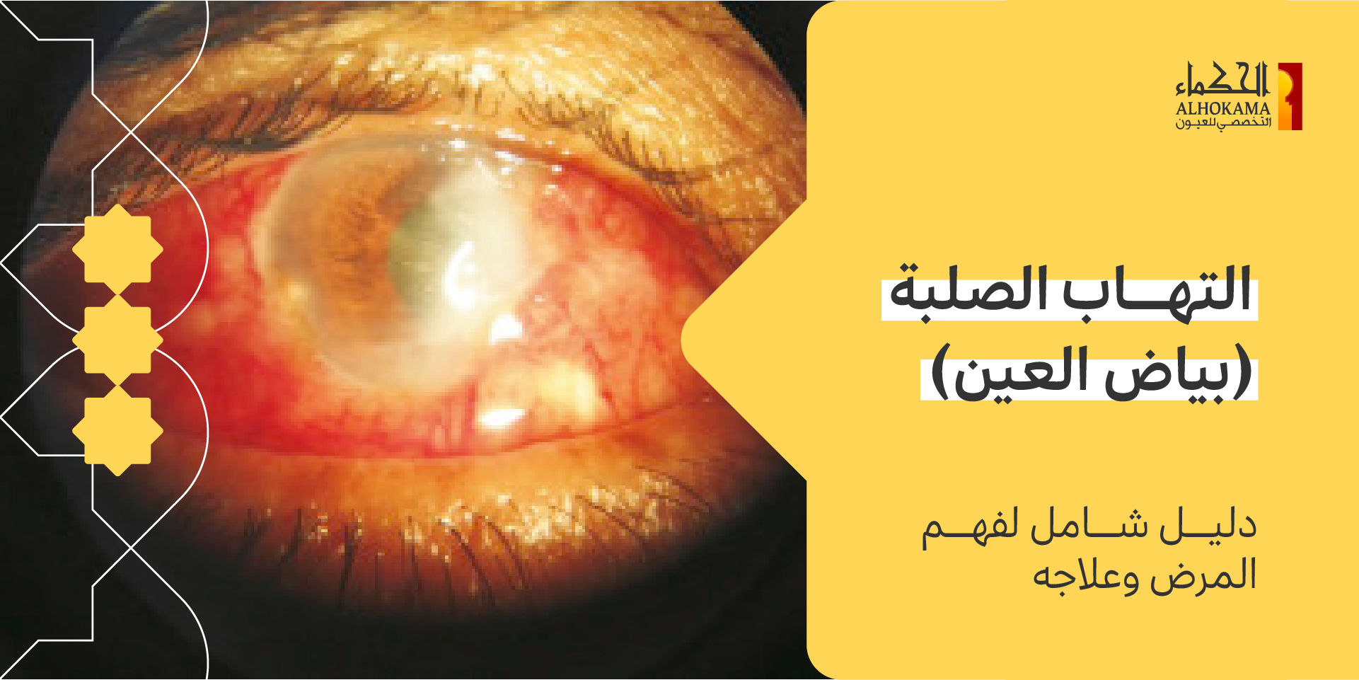 التهاب الصلبة