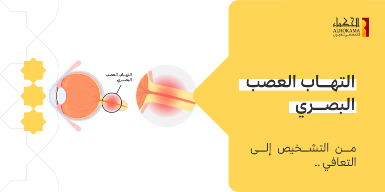 التهاب العصب البصري