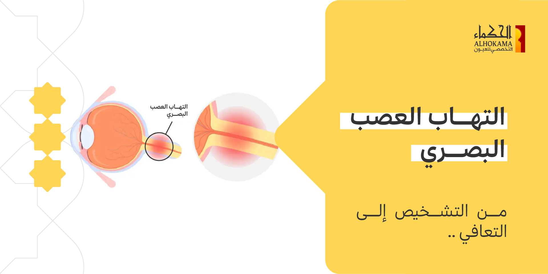 التهاب العصب البصري
