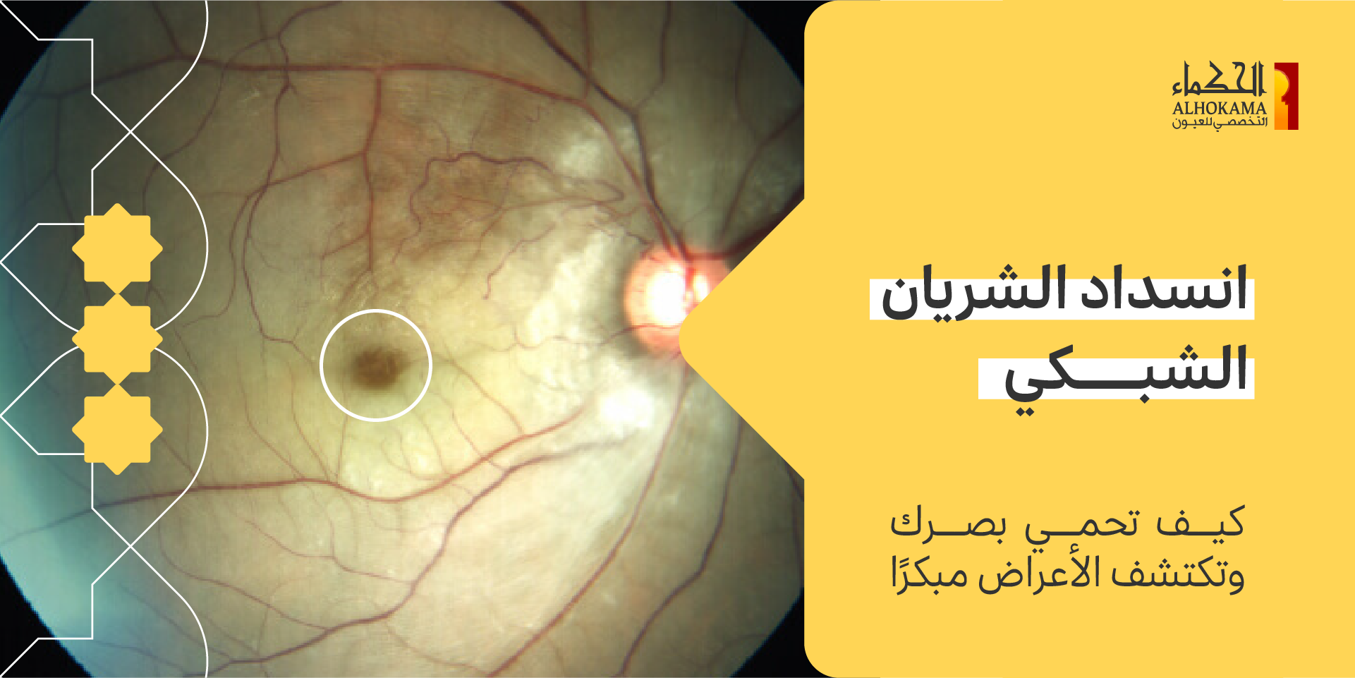 انسداد الشريان الشبكي