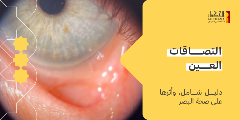 التصاقات العين