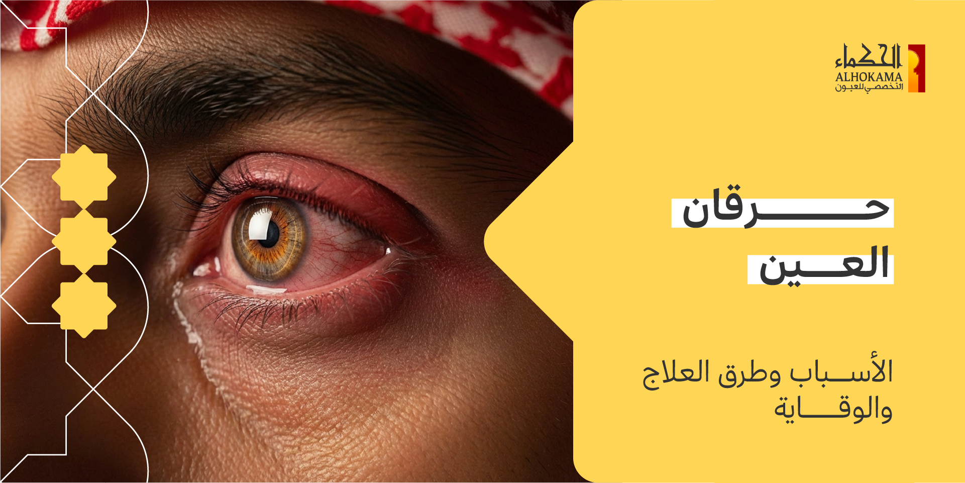 حرقان العين