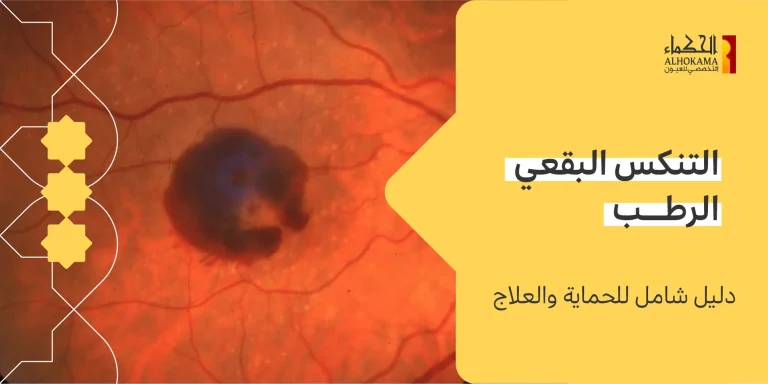التنكس البقعي الرطب